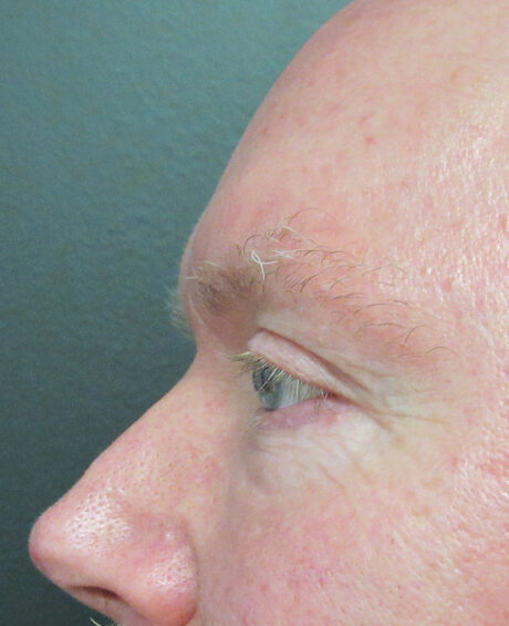 Eyelid Surgery case #4373