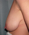 Breast Lift case #4558