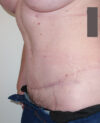 Tummy Tuck case #4096