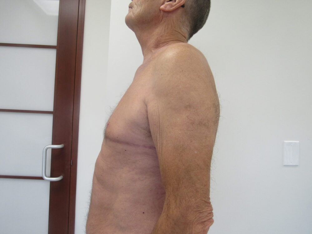 Gynecomastia case #4213