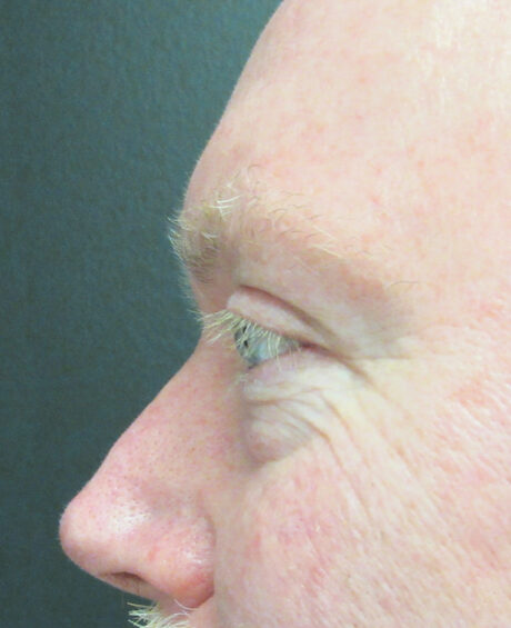 Eyelid Surgery case #4373