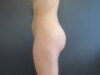 Brazilian Butt Lift case #4483