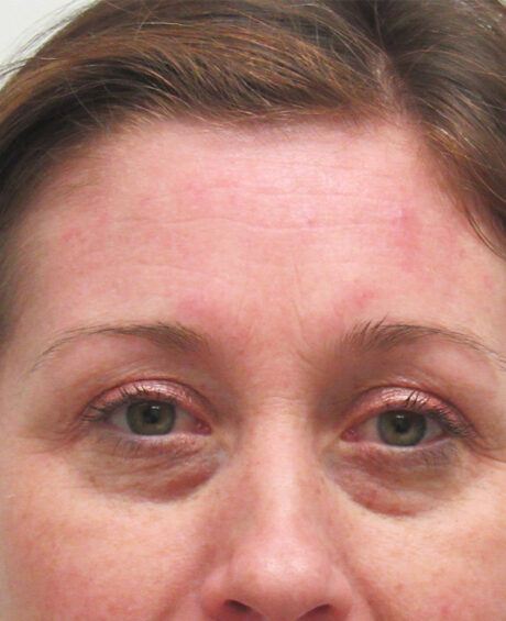 BOTOX® Cosmetic case #4265