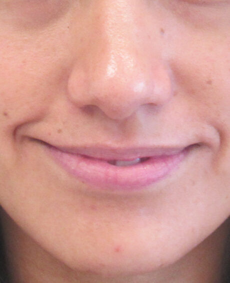 Dermal Fillers case #4313