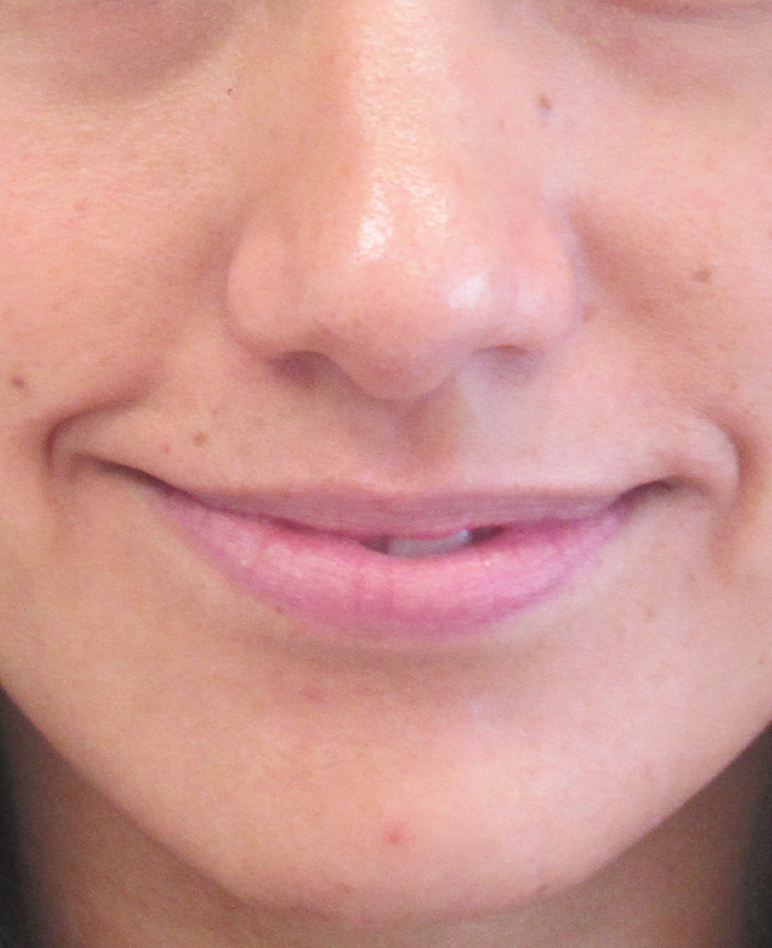 Dermal Fillers