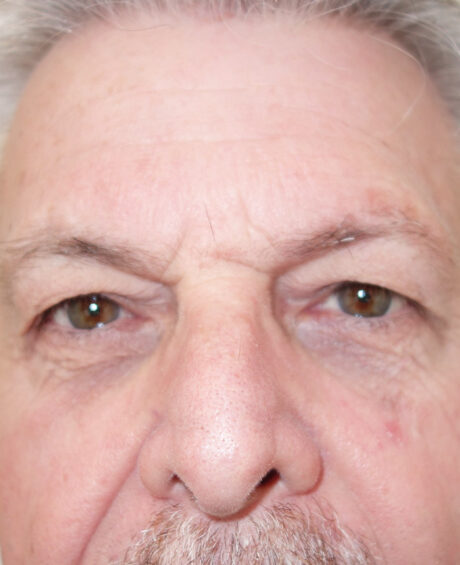 Eyelid Surgery case #4378
