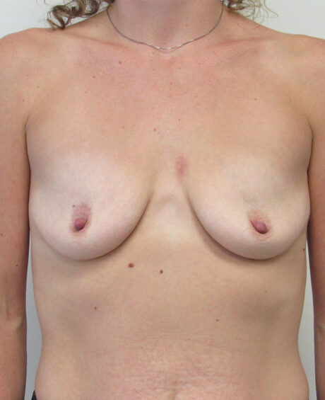 Breast Augmentation case #4048