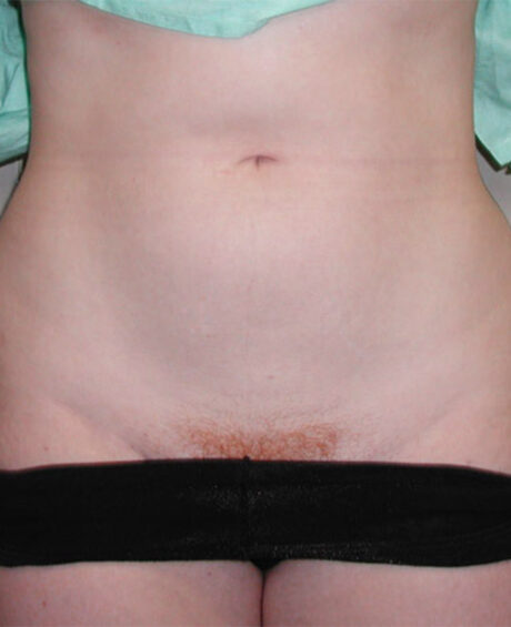 Liposuction case #4501