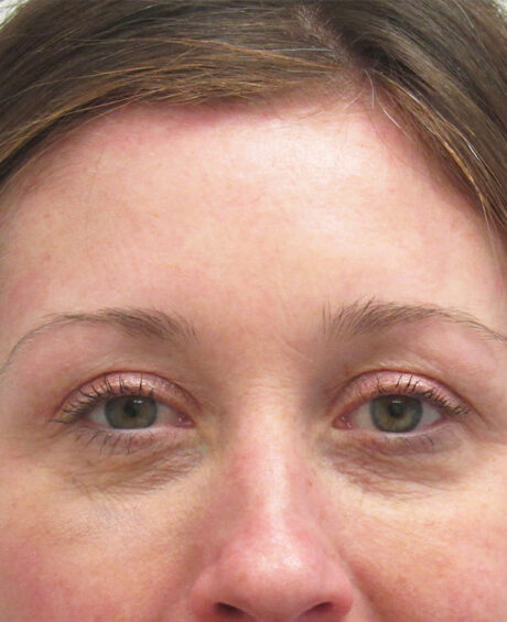 BOTOX® Cosmetic case #4265