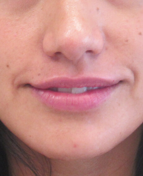 Dermal Fillers case #4313