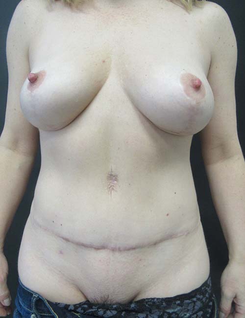 Breast Lift case #4563