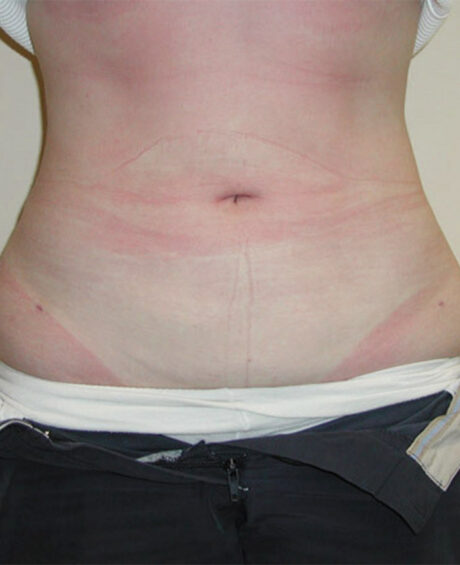 Liposuction case #4501