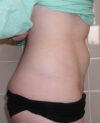 Liposuction case #4501