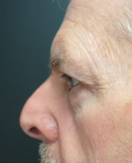 Eyelid Surgery case #4378