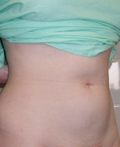 Liposuction case #4501