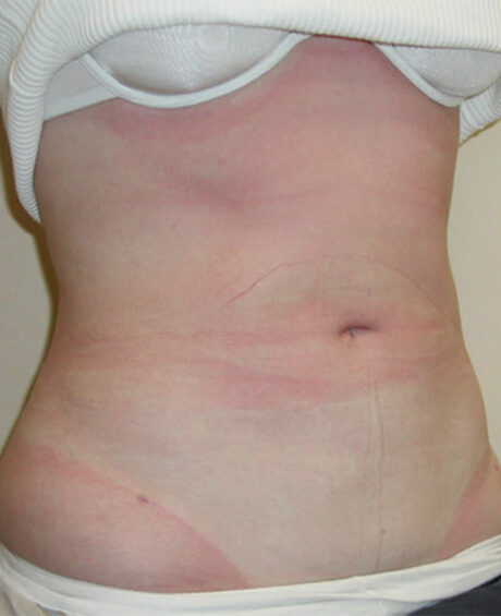 Liposuction case #4501