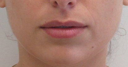 Dermal Fillers case #4316