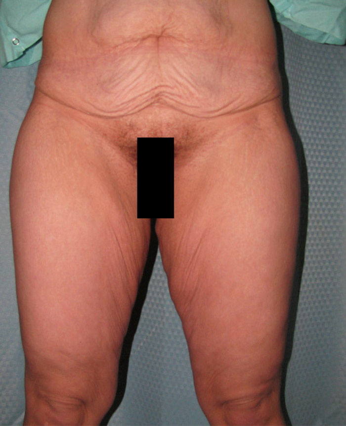 Tummy Tuck case #4104