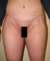 Tummy Tuck case #4104