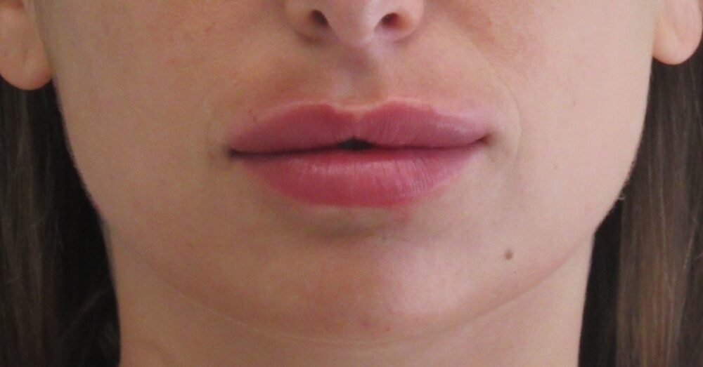 Dermal Fillers case #4316