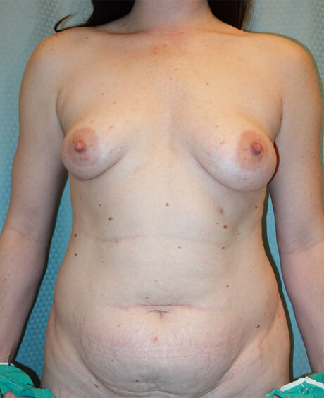 Breast Augmentation case #4617