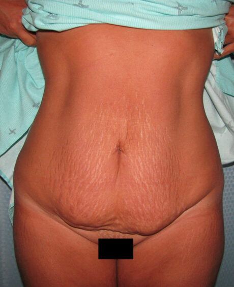 Tummy Tuck case #4107