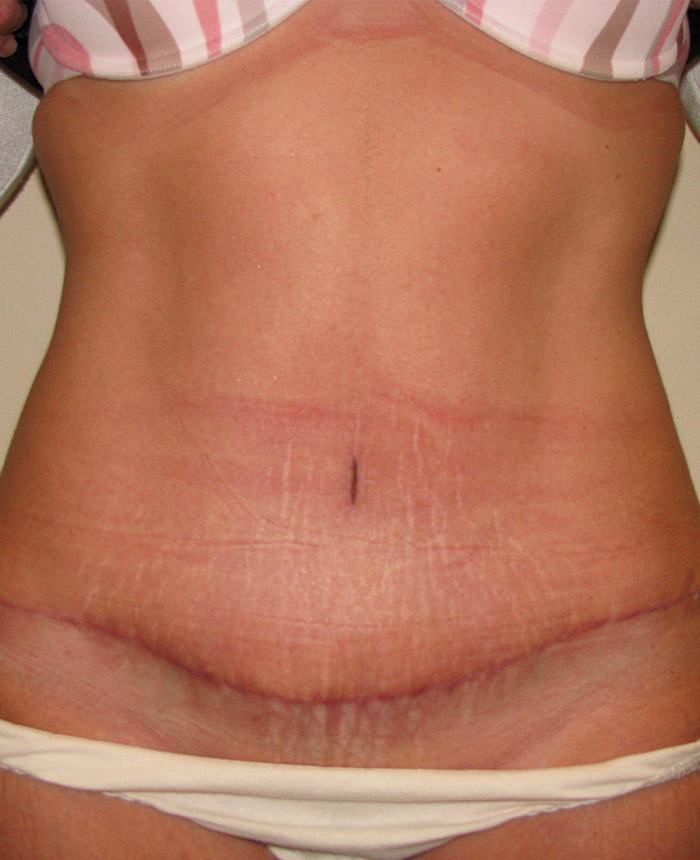 Tummy Tuck case #4107