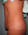 Tummy Tuck case #4107