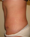 Tummy Tuck case #4107