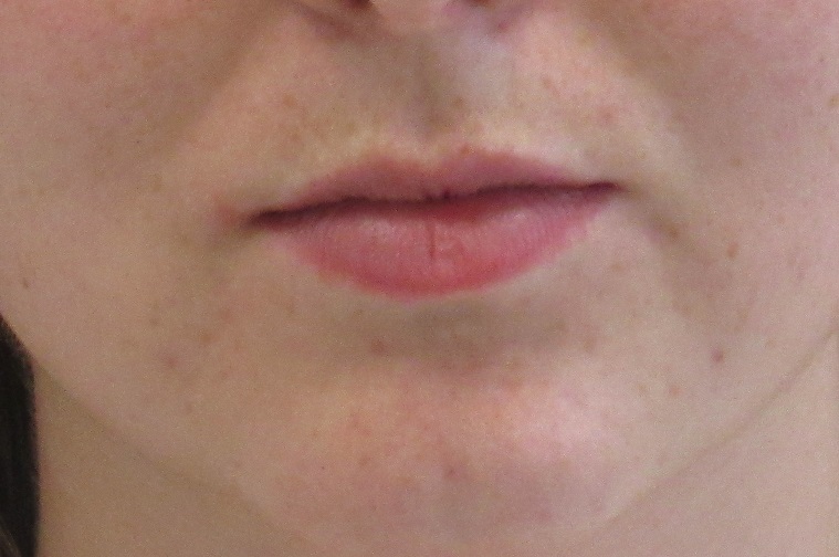 Dermal Fillers case #4322