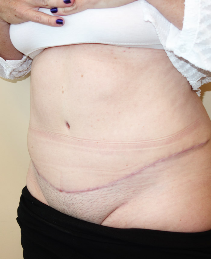 Tummy Tuck case #4112