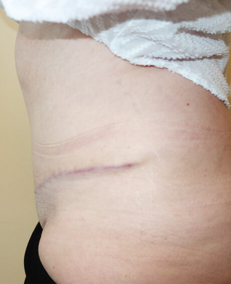 Tummy Tuck case #4112