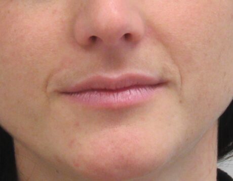 Dermal Fillers case #4325