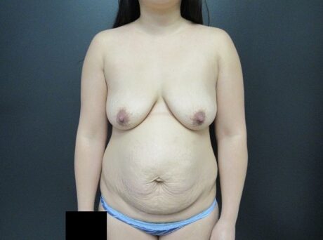 Breast Augmentation With Lift case #4609