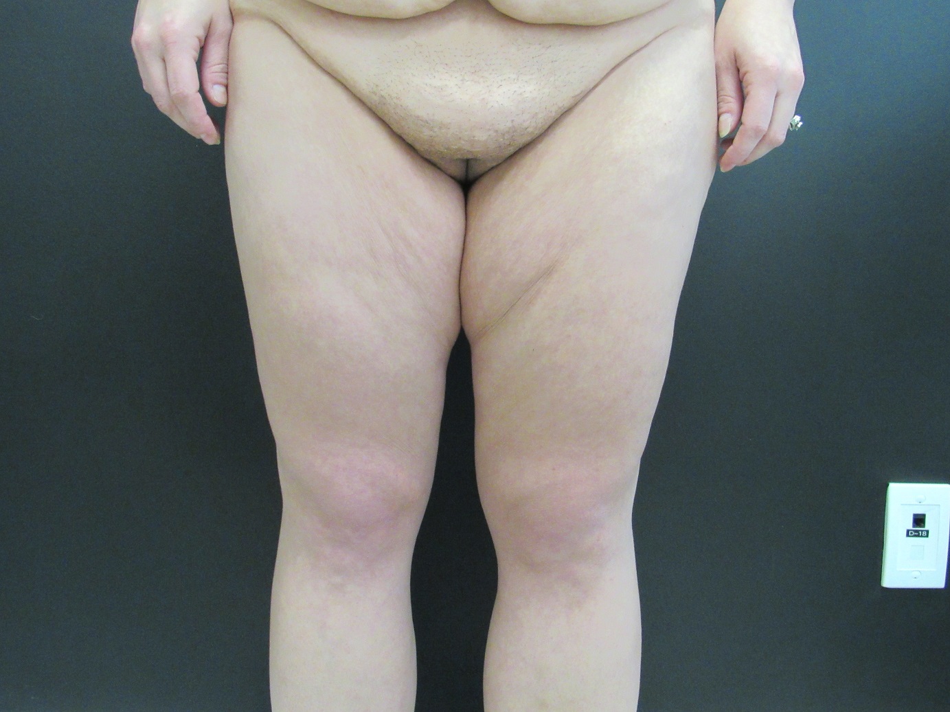 After Weight Loss