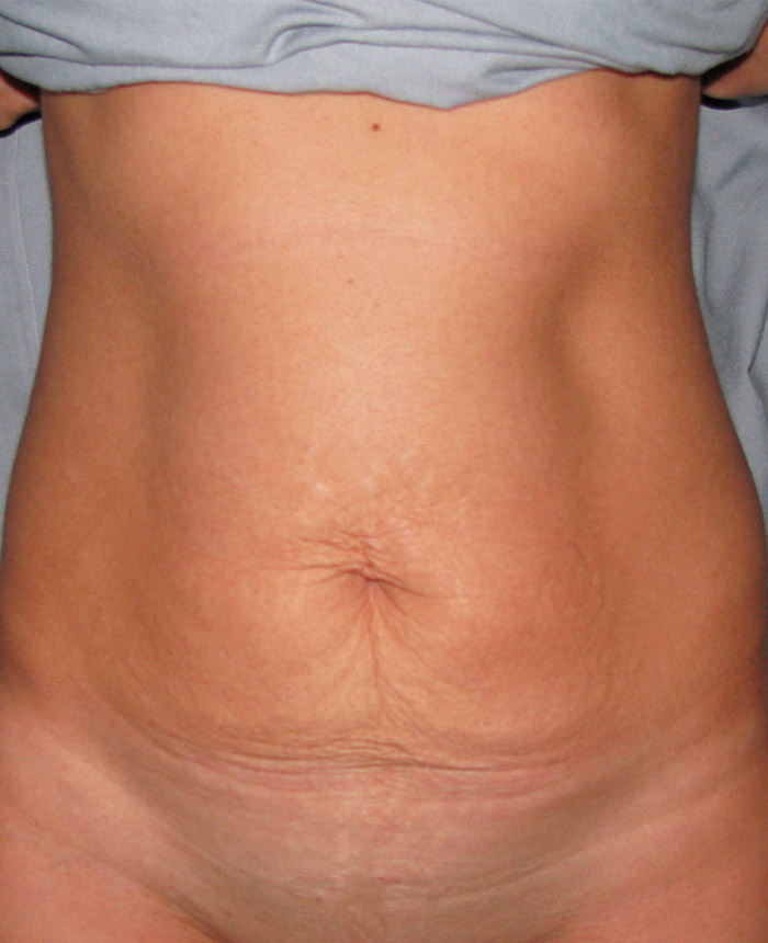 Tummy Tuck