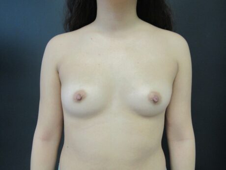 Breast Augmentation case #4627