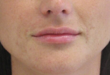 Dermal Fillers case #4325