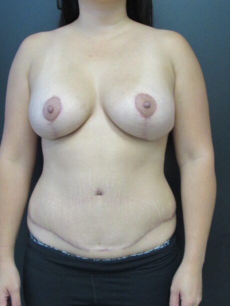 Breast Augmentation With Lift case #4609