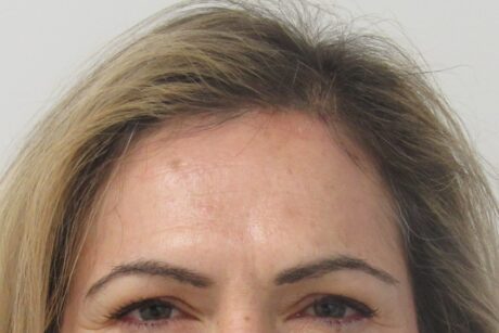 BOTOX® Cosmetic case #4277