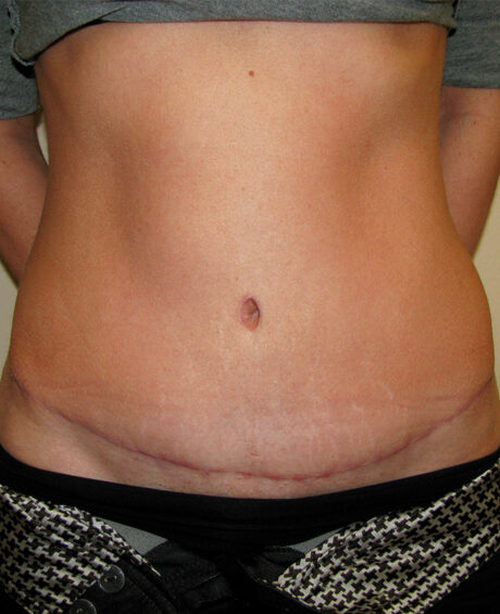 Tummy Tuck case #4117