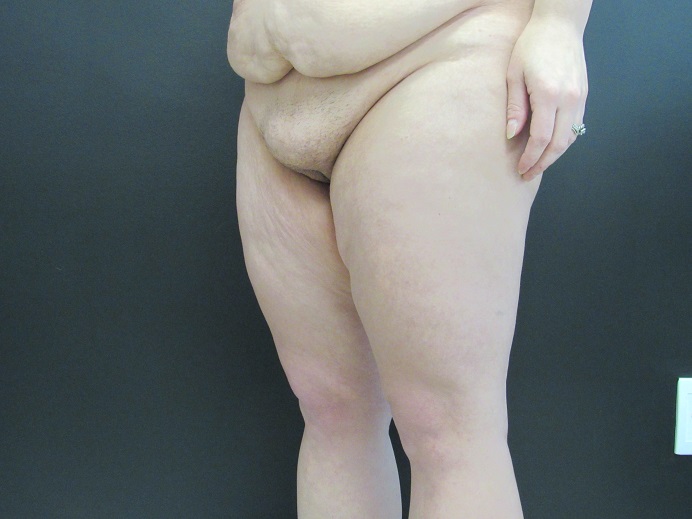 After Weight Loss