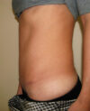 Tummy Tuck case #4117