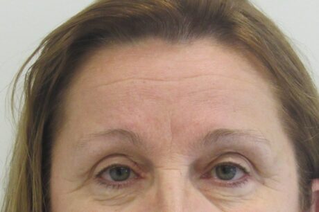 BOTOX® Cosmetic case #4280