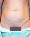 Tummy Tuck case #4122