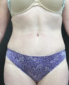 Tummy Tuck case #4122