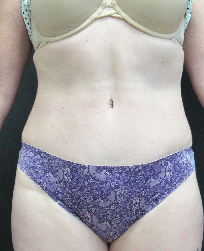 Tummy Tuck