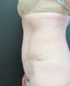 Tummy Tuck case #4122