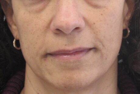 Dermal Fillers case #4331