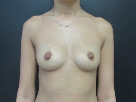 Breast Augmentation case #4639